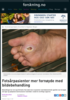 Fotsårpasienter mer fornøyde med bildebehandling